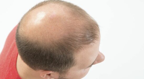 Finasteride Europe re evaluates anti baldness drug due to serious side effects