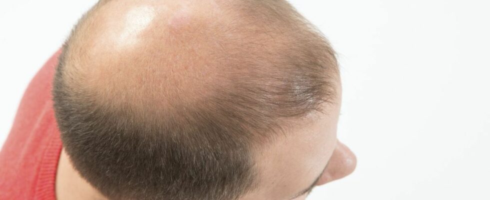 Finasteride Europe re evaluates anti baldness drug due to serious side effects