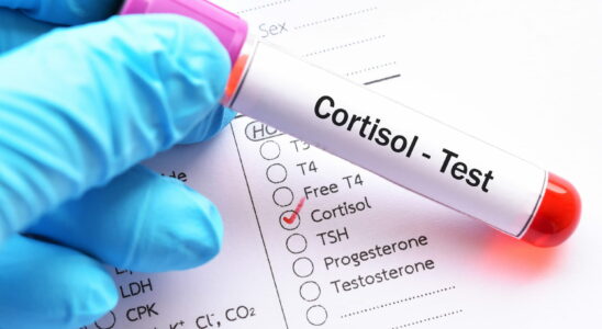 Hypertension the cortisol level should not be exceeded