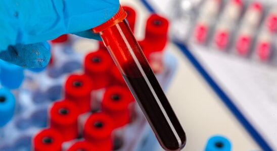 People with this blood type are at greater risk of