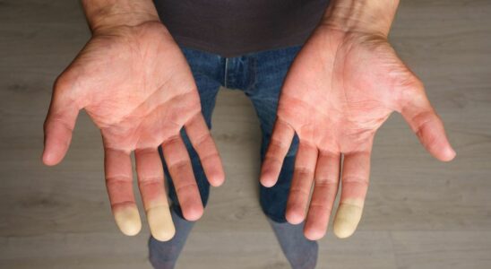 Do you often have cold hands Find out in 5