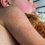 Measles a 20 increase in cases in 2023 linked to