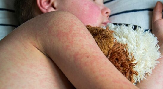 Measles a 20 increase in cases in 2023 linked to