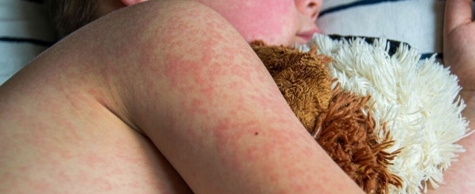 Measles a 20 increase in cases in 2023 linked to