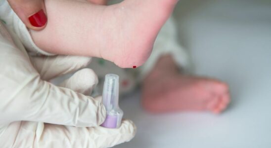 Sickle cell screening for all newborns in France from November