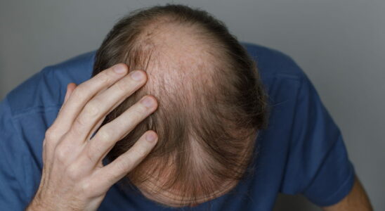 This Male Hair Loss Treatment Works Better Than Others