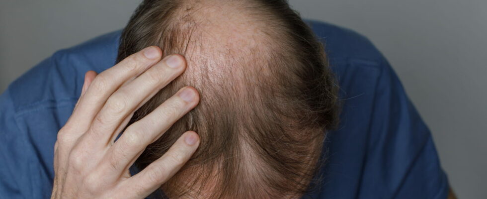 This Male Hair Loss Treatment Works Better Than Others