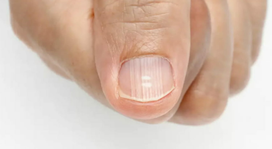 What ridged nails say about health and proper functioning of