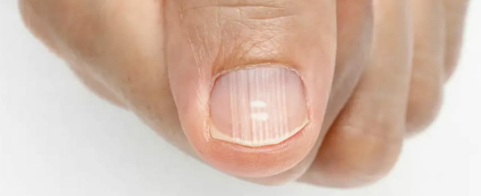 What ridged nails say about health and proper functioning of