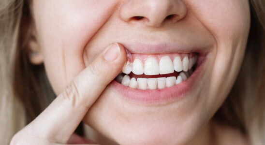 How to delay tooth loss as you age