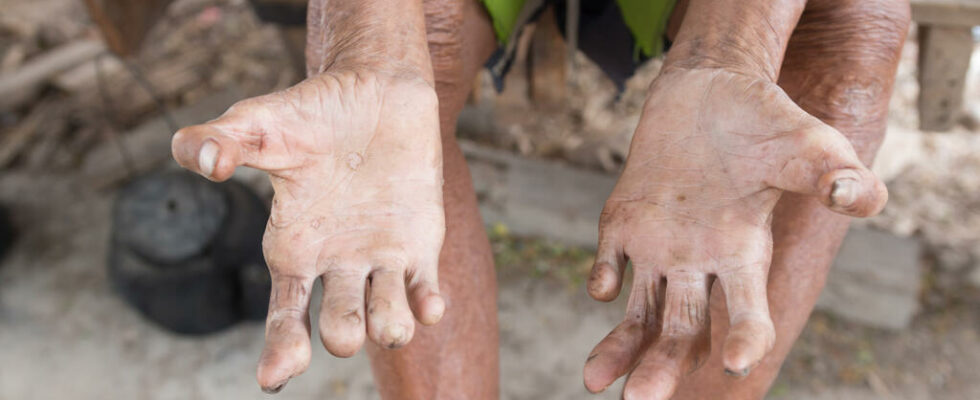 World day against leprosy a fight also waged in the