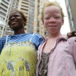 Congo B soon locally manufactured creams to protect albinos