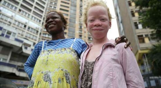 Congo B soon locally manufactured creams to protect albinos