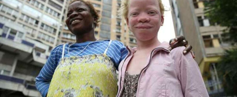 Congo B soon locally manufactured creams to protect albinos