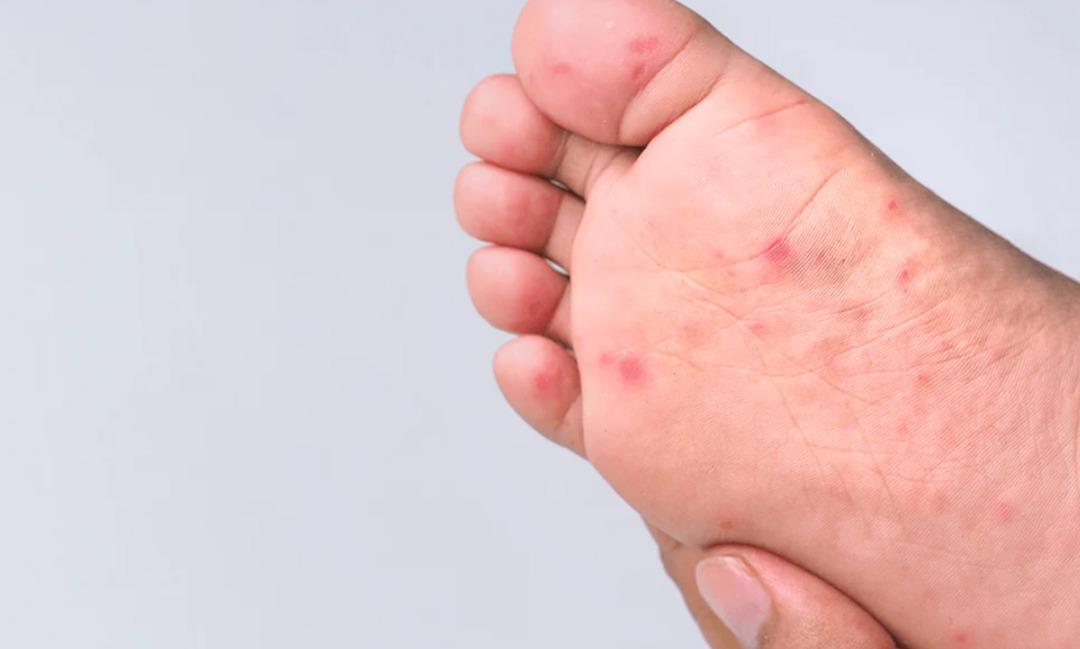 measles foot