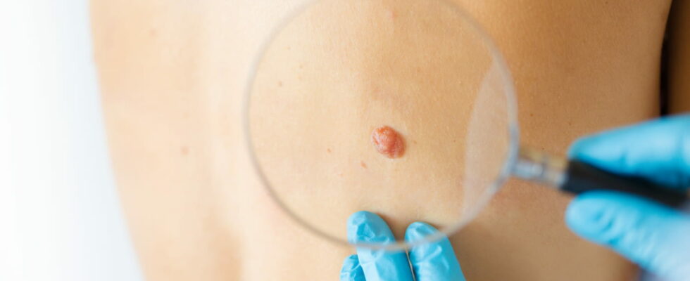 Melanoma What does this skin cancer look like