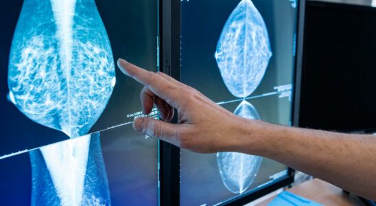 Success when AI is looking for breast cancer