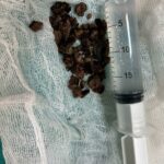 6 centimeters of stone was removed from a persons kidney