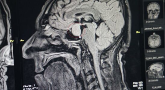 A first in health in Turkiye Tumor in the brain