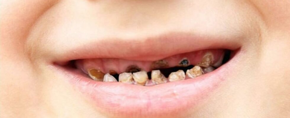 Is there rotten on your teeth Problems in the mouth