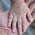 Measles have returned Cases are at the highest level of