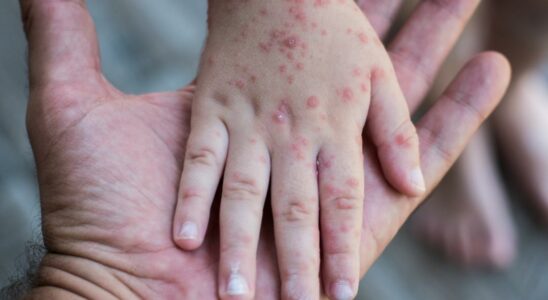 Measles have returned Cases are at the highest level of