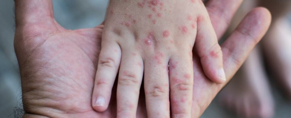 Measles have returned Cases are at the highest level of