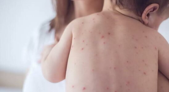 Measles the highest number of cases after 27 years Alarm