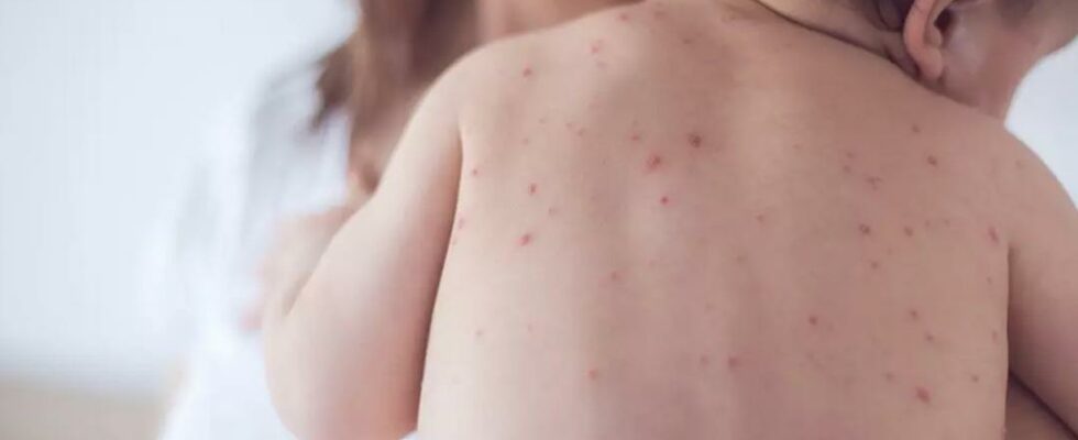 Measles the highest number of cases after 27 years Alarm